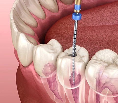 img-Endodontist-lp