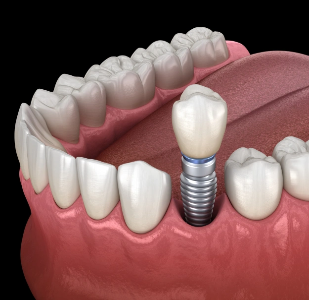 img-dental-implants